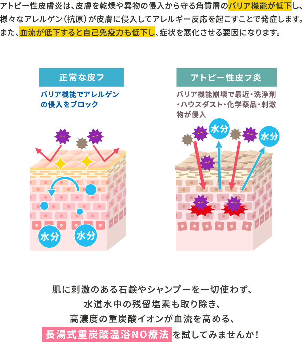 アトピー性皮膚炎は、皮ふを乾燥や異物の侵入から守る角質層のバリア機能が低下し、様々なアレルゲン(抗原)が皮膚に侵入してアレルギー反応を起こすことで発症します。
